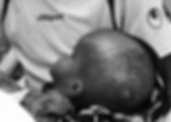 SERIKALI YAVALIA NJUGA TATIZO LA VICHWA VIKUBWA, MGONGO WAZI