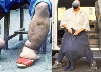 WATU MILIONI TANO KUPATA KINGA YA MATENDE, MABUSHA