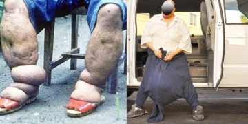 WATU MILIONI TANO KUPATA KINGA YA MATENDE, MABUSHA