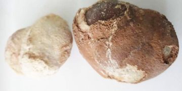 UTI MARA KWA MARA DALILI YA MAWE KWENYE FIGO