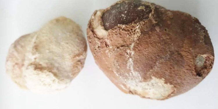 UTI MARA KWA MARA DALILI YA MAWE KWENYE FIGO